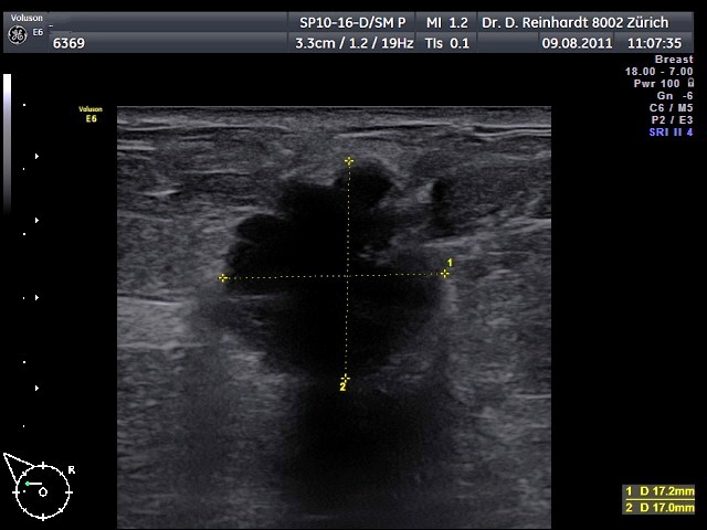 Bösartiger Tumor Brust Ultraschall Bilder www.gyne-city.ch